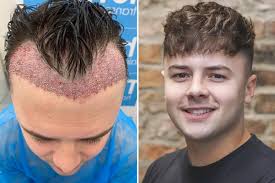 Affordable Turkey Hair Transplant Cost: What You Need to Know